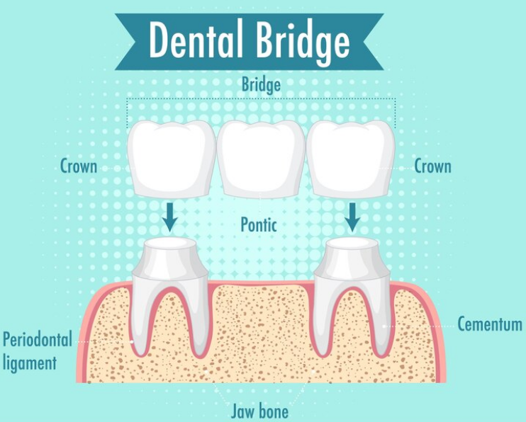 Best Bridges and Crown in Gamdevi